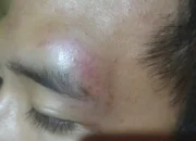 Ketua Kelas di Way Kanan Babak Belur Dianiaya Rekannya